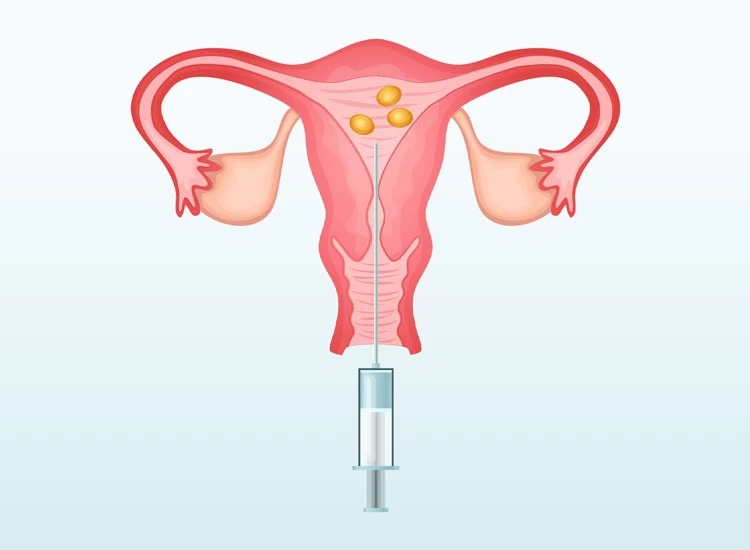 كم تستغرق عملية الحقن المجهري