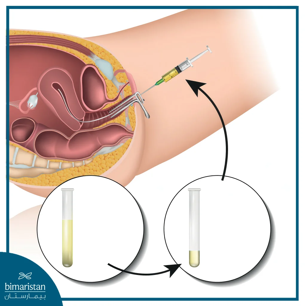كيف يتم الحقن الصناعي