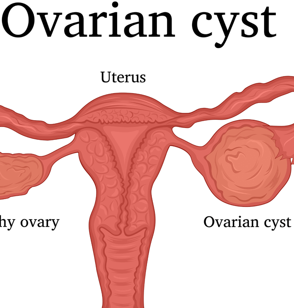 ما هو تكيس المبايض