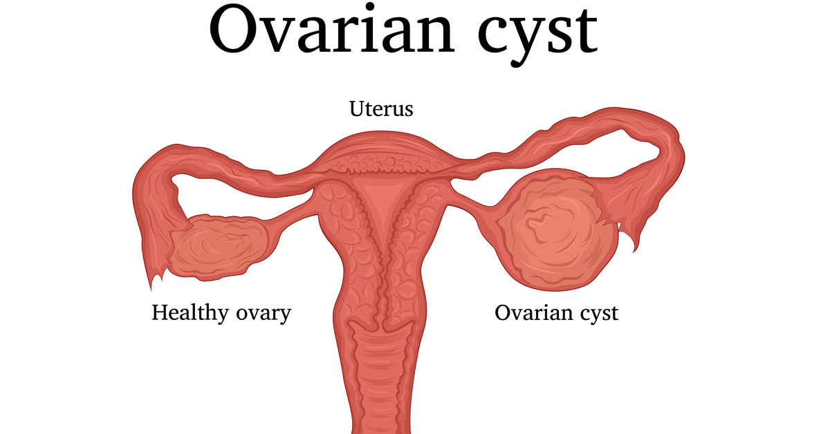ما هو تكيس المبايض