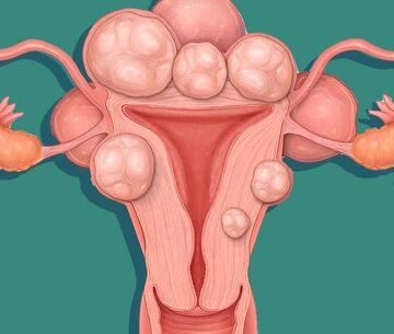 ما هي الاورام الليفية في الرحم