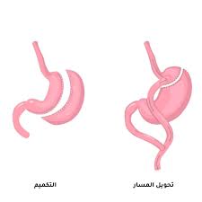 ما هي الدعامة الذكرية