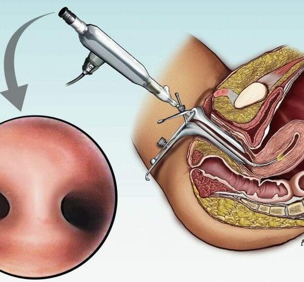 منظار الرحم التشخيصي