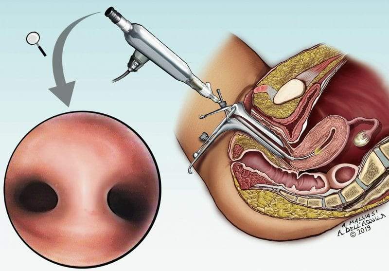 منظار الرحم التشخيصي
